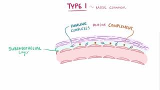 Membranous Nephropathy vs Membranoproliferative Glomerulonephritis [upl. by Balkin]