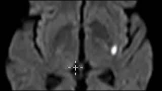 Swallowing and Communication after Stroke [upl. by Lletniuq]