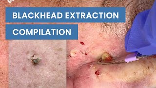 Extraction Satisfaction Blackhead Removal  CONTOUR DERMATOLOGY [upl. by Chaworth]