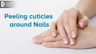 What to do for peeling cuticles around nails  Dr Rasya Dixit  Doctors Circle [upl. by Lurie]