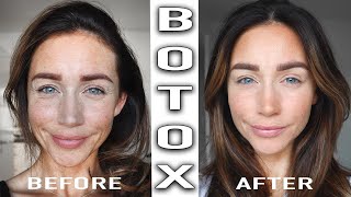 BOTOX TREATMENT BEFORE amp AFTER [upl. by Ennovyahs129]