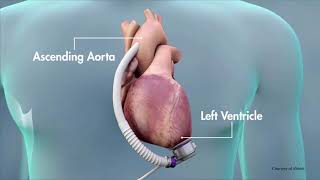 Heart Mate 3 LVAD [upl. by Barraza]