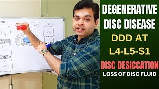 Degenerative Disc Disease DDD L4 L5 L5 S1Disc Desiccation Disc Degeneration Disease Treatment [upl. by Auqinehs]