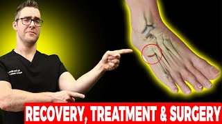 5th Metatarsal Jones Fracture Recovery Treatment amp Surgery [upl. by Sloan470]