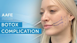 Correcting Unbalanced Botox at His Follow Up Appointment  AAFE [upl. by Ben]