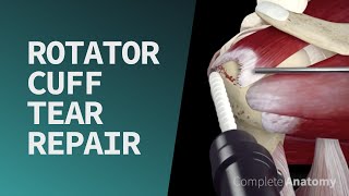 Rotator Cuff Tear Repair [upl. by Docia]