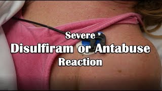 Disulfiram or Antabuse Reaction Emergency [upl. by Auhsuj]