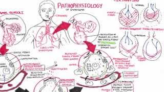 Emphysema  Pathophysiology COPD [upl. by Nairehs890]