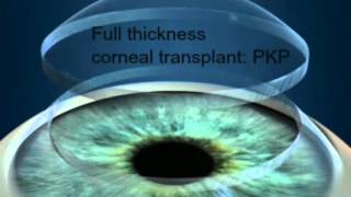 Cornea 2 Corneal Surgery [upl. by Guenzi24]