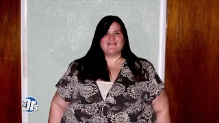 Watch Skin Removal Surgery for Woman that Lost 280 Pounds [upl. by Ruenhcs6]