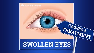 Swollen Eyelid Causes amp Treatment [upl. by Booker]