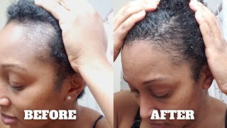 How I Grew My Edges Back Using Wild Growth Hair Oil [upl. by Dittman868]