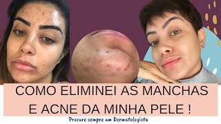 COMO ELIMINEI AS MANCHAS E ACNE DA MINHA PELE [upl. by Kiyohara]