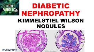 DIABETIC NEPHROPATHY Pathophysiology amp Morphology [upl. by Aerol301]