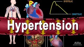 Hypertension  High Blood Pressure Animation [upl. by Iteerp804]