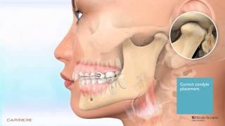 Carriere® Motion™ Appliance for Class II Patient Education Animation 2 [upl. by Marney]