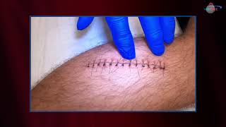 WCW Removing Sutures from a Leg Laceration [upl. by Stanley]