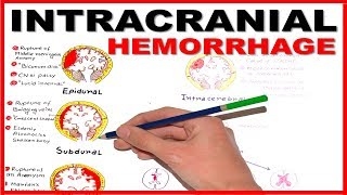 The lenticulostriate vessels and lacunar infarcts [upl. by Daley]