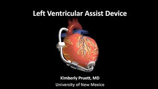 HeartMate 2 LVAD Warnings [upl. by Aharon]