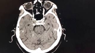 MCA Infarct Stroke [upl. by Arreyt]