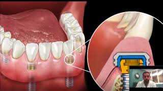 Dental Implant Overdenture  SnapIn Dentures [upl. by Onez]