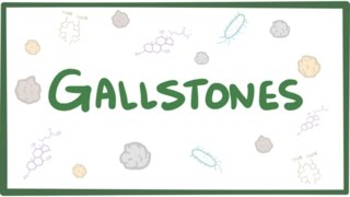 Gallstones cholelithiasis [upl. by Ahseina]