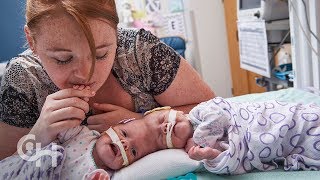 Conjoined twins after surgery Separated and a success [upl. by Nat]