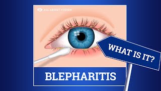 Blepharitis red swollen eyelids Causes Symptoms Treatments [upl. by Nyllaf]