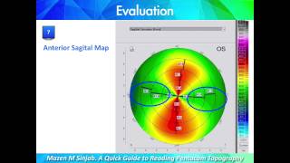 A Quick Guide to Reading Corneal Topography Part 1 [upl. by Lletnahs818]