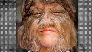 Hypertrichosis Do Werewolves Really Exist [upl. by Charmian587]