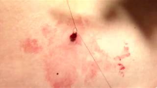 Melanoma Lentigo Maligna Type vs Dysplastic Nevus 5Minute Pathology Pearls [upl. by Asenab]