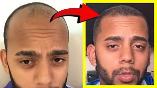 Crazy Minoxidil 5 Hair Growth in 25 Months Fails after 25 YEARS Heres WHY [upl. by Fellner]