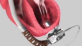 Left Ventricular Assist Device  LVAD Procedure [upl. by Patrice633]