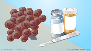 Treating Melanoma [upl. by Atinat]