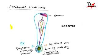 Radicular cyst  PATHOGENESIS CF RF amp TREATMENT [upl. by Anerac370]