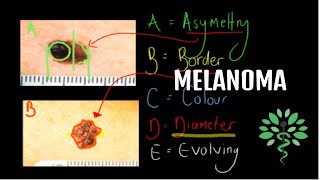 Melanoma Causes Signs and Symptoms DIagnosis and Treatment [upl. by Ahsekel]