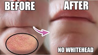 Come rimuovere brufoli e punti neri dal mento a casa How To Remove Whiteheads And Blackheads [upl. by Oizirbaf]