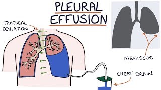 Understanding Pleural Effusions [upl. by Tshombe541]