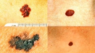 Atypical Moles or Melanoma The ABCDEs Dermatology [upl. by Buhler]