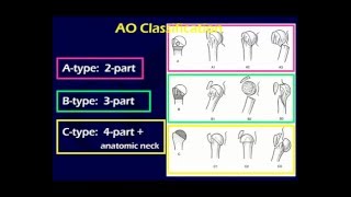 Proximal Humerus Fractures 1 OTA lecture series III u03a [upl. by Anaizit]