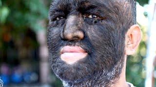 Meet the Worlds Hairiest Man [upl. by Ontine]