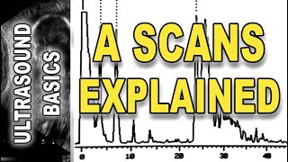 ultrasound  A scans explained [upl. by Mure839]