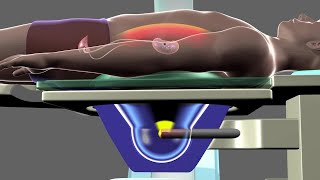 Shockwave Lithotripsy [upl. by Rudie]