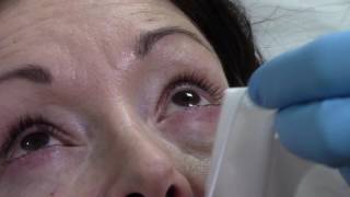 Blephex Blepharitis Treatment at Face amp Eye [upl. by Anitnegra]