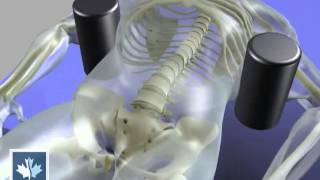 Sciatica  Spinal Decompression  Back Clinics of Canada [upl. by Lyford]