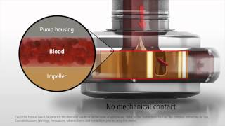 LVAD  VENTRICULAR ASSIST DEVICE  HEARTMATE ECHO [upl. by Huebner]