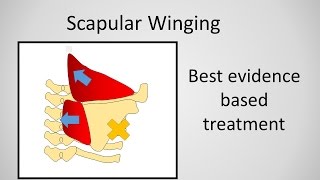 Scapular Winging Causes and Treatment [upl. by Tal]