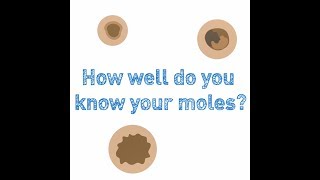 Atypical Moles What Are They Dermatology 2019 [upl. by Ahseet]