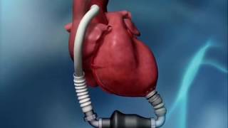 Living with LVAD [upl. by Eidahs]