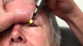 Blepharitis Treatment That Really Works Blephex Eyelid Cleaning [upl. by Adnulahs968]